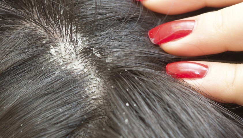 How to Get Rid of an Itchy Scalp